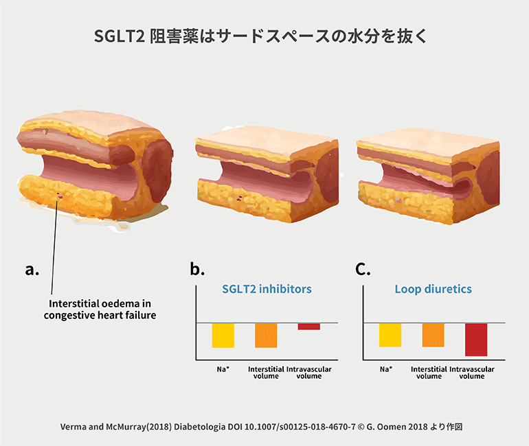 SGLT2阻害薬はサードスペースの水分を抜く＠第35話 SGLT2阻害薬 For what?　野見山崇
