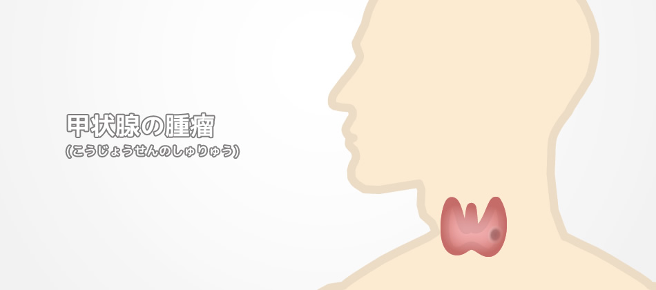  甲状腺の腫瘤  (こうじょうせんのしゅりゅう)